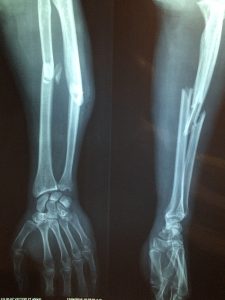 fracture-bone-2333164_1920-225x300.jpg