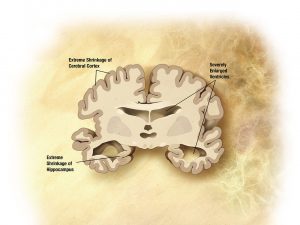 Alzheimers_disease_brain_severe-300x225.jpg