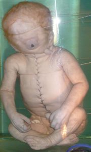 Child_with_Cyclopia-180x300.jpg